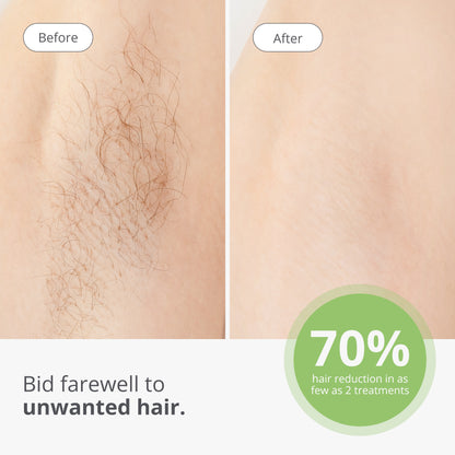 Hair Removal Laser 4X